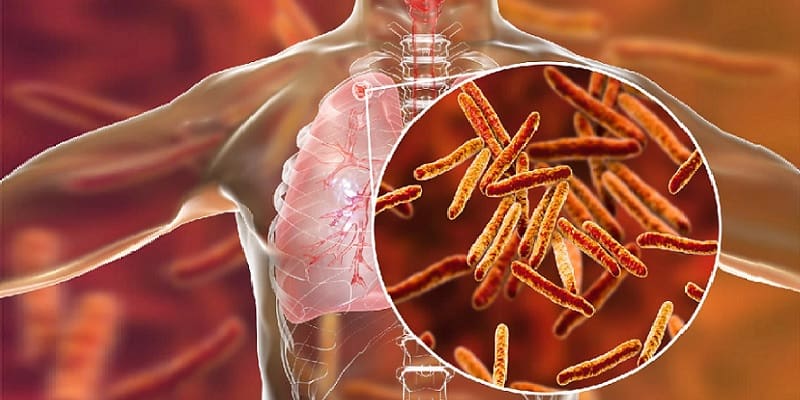 ilustrasi tuberkulosis atau TBC paru-paru