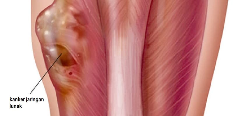 gejala kanker jaringan lunak