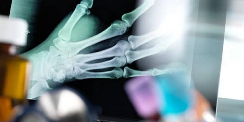 ilustrasi cedera patah tulang