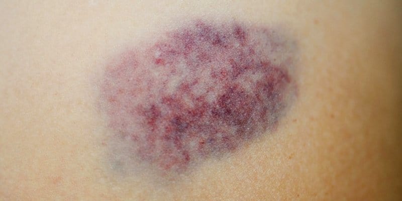 Gejala Kanker Leukemia Selain Benjolan Ketiak