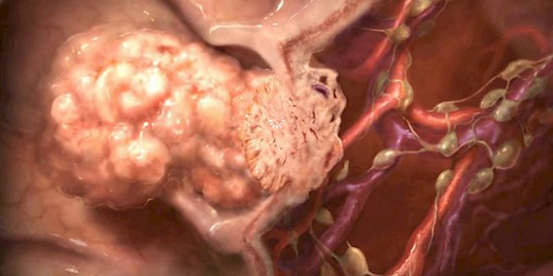 Ilustrasi pertumbuhan kanker