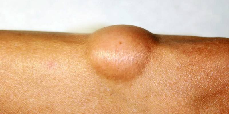 Bedakan Lipoma dengan Kanker Liposarkoma
