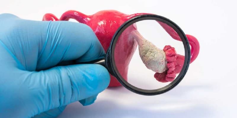 Ilustrasi ciri-ciri kanker kista