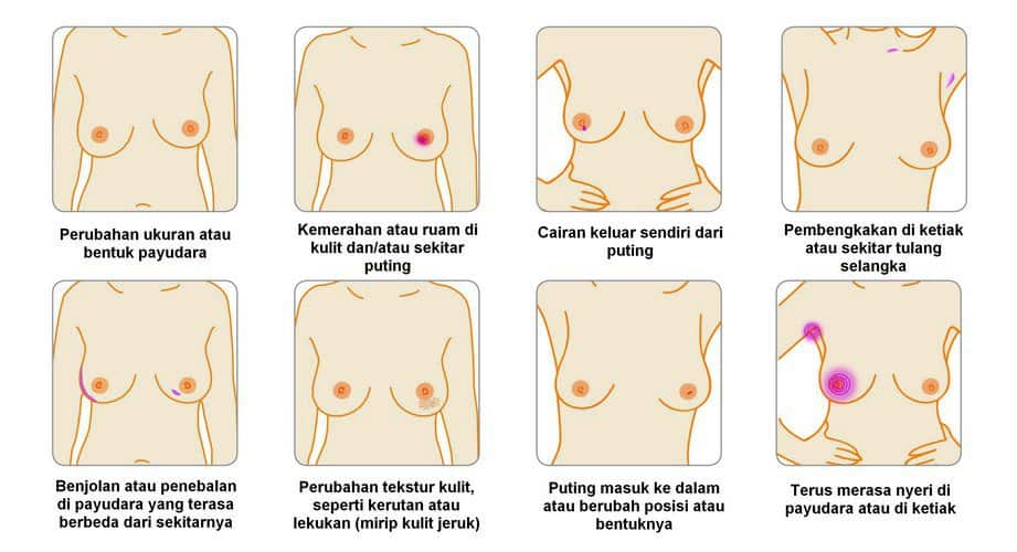 Ilustrasi Cara Deteksi Dini Kanker Payudara