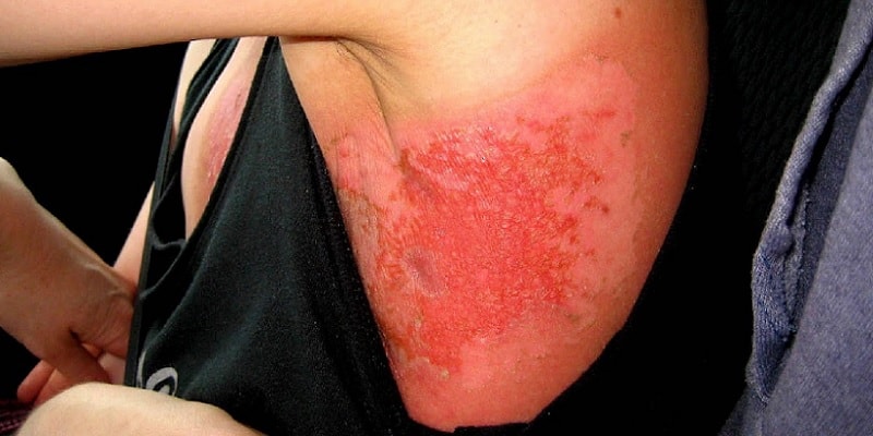 efek samping radioterapi kanker payudara