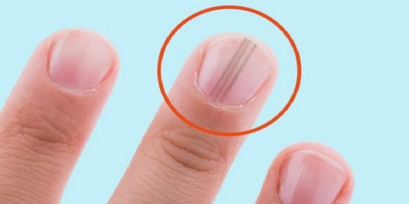 gejala kanker kulit melanoma pada kuku