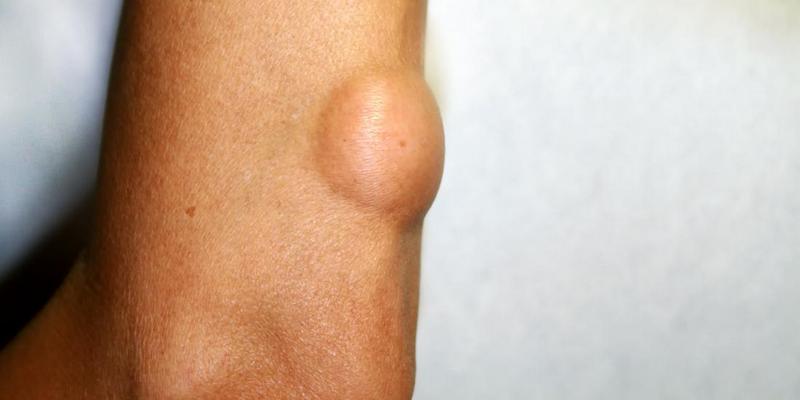 Benjolan Lipoma di Tangan, Sejenis Tumor Jinak