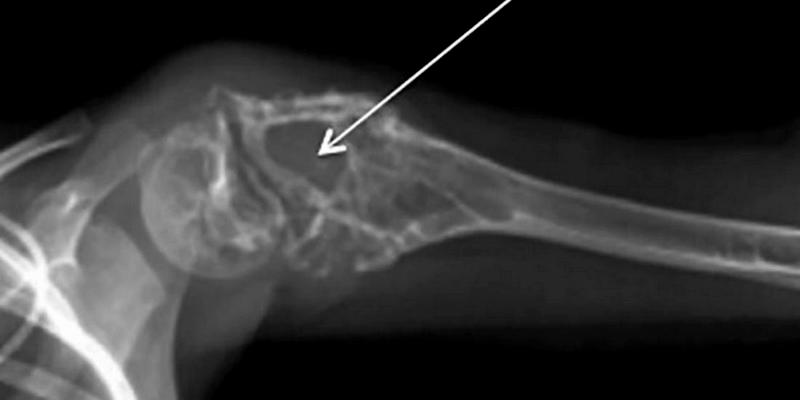 Ilustrasi Gejala Kanker Sarkoma Ewing