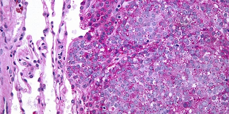 Ilustrasi Metastasis Sarkoma Ewing di Paru-Paru