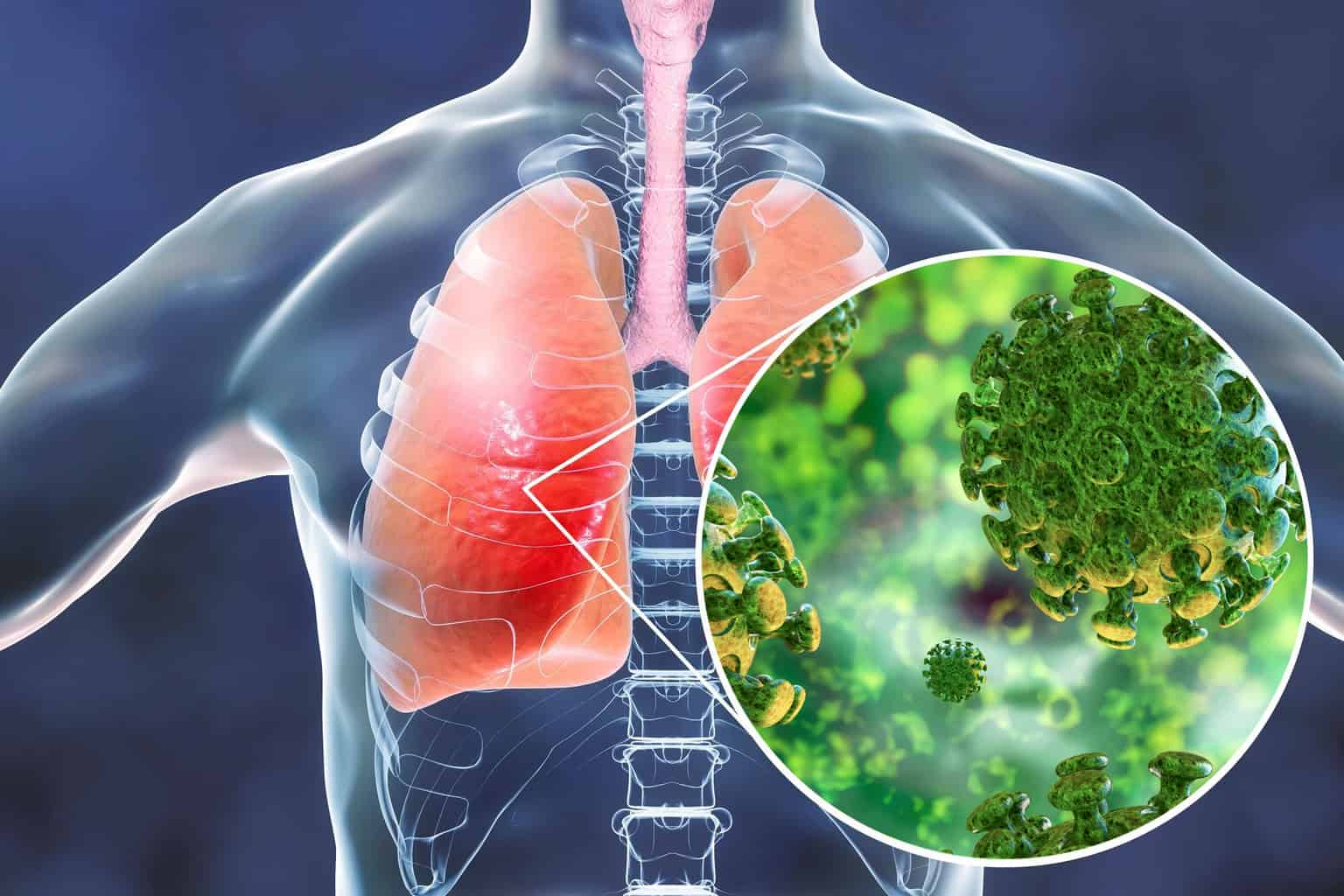 Ilustrasi Penyakit Pneumonia yang Disebabkan oleh Virus Corona