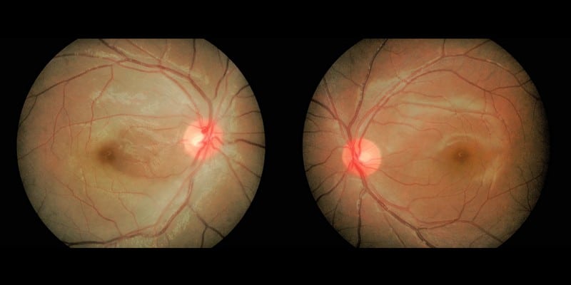 Ilustrasi Penyebab Mata Buta Mendadak
