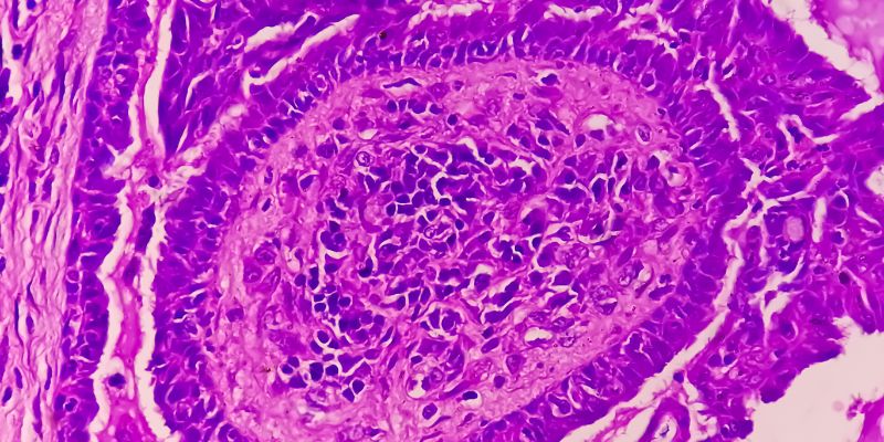 Ilustrasi tanda-tanda kanker endometrium