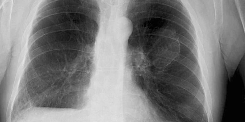 Apa yang Dimaksud Asbestosis?