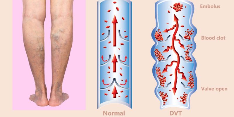 Ilustrasi Penyebab Varises di Kaki Setelah Melahirkan