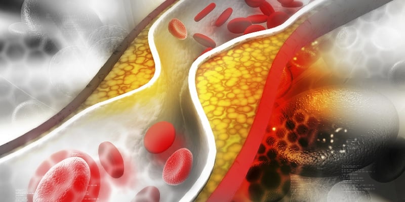 Mitos Penyakit Kolesterol