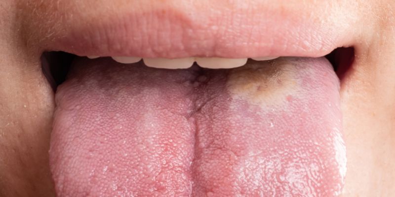 Ilustrasi Gejala Bercak Putih di Lidah