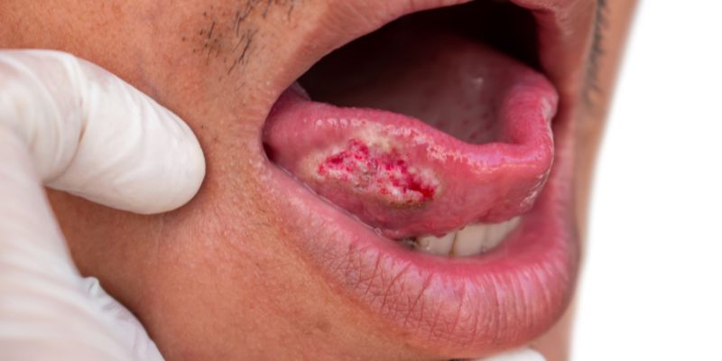 Ilustrasi Gejala Kanker Lidah (Karsinoma Sel Skuamosa)