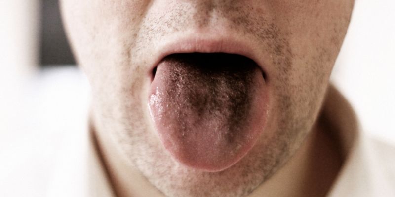 Ilustrasi Gejala Lidah Hitam