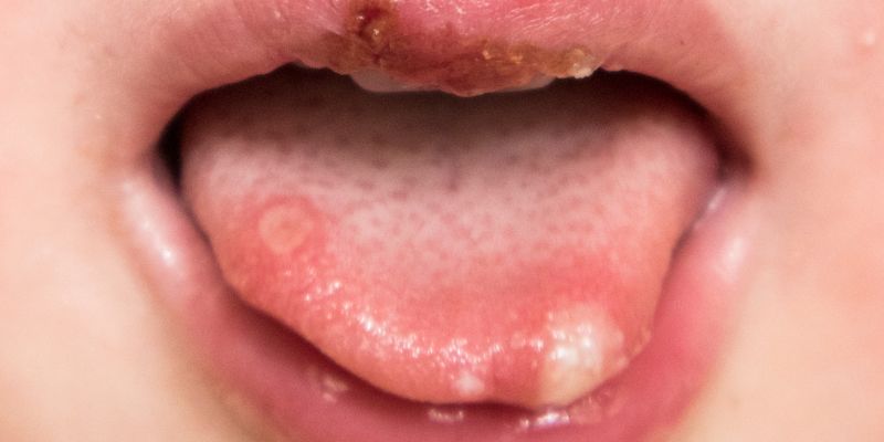 Ilustrasi Gejala Penyakit pada Lidah