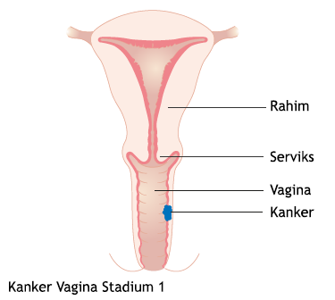 Kanker Vagina Stadium 1