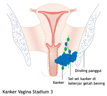 Kanker Vagina Stadium 3