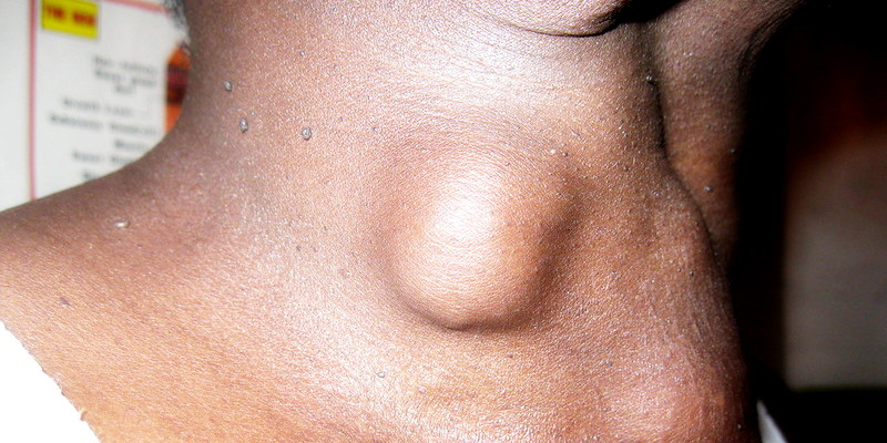 Ilustrasi Kanker Tiroid Penyebab Benjolan di Leher