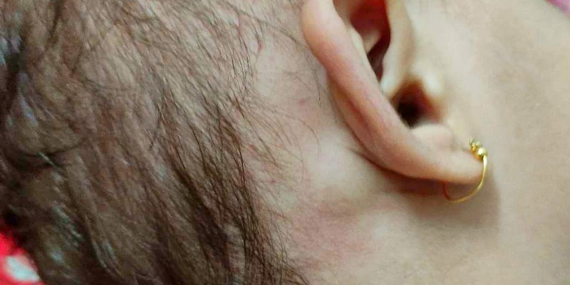 Gambar Benjolan di Belakang Telinga Bayi