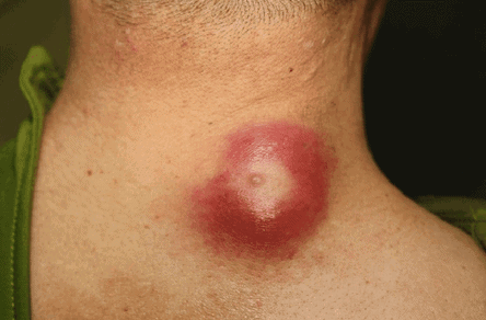 Gambar Kista Epidermoid yang Terinfeksi