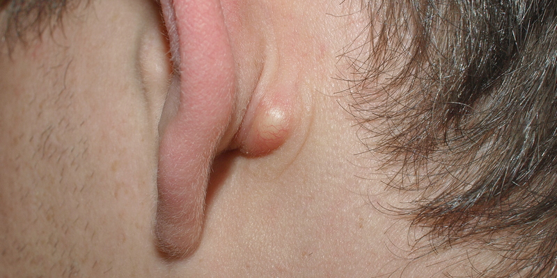 Gambar Benjolan di Belakang Telinga