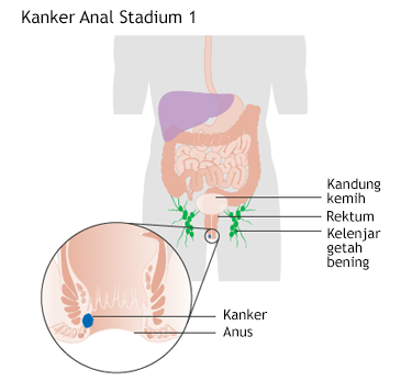 Ilustrasi Kanker Anal Stadium 1