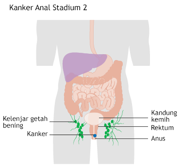 Ilustrasi Kanker Anal Stadium 2