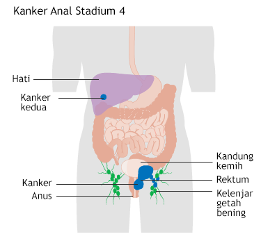 Ilustrasi Kanker Anal Stadium 4