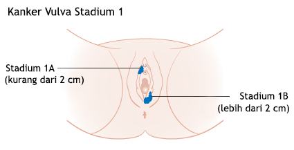 Ilustrasi Kanker Vulva Stadium 1