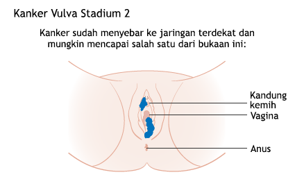 Ilustrasi Kanker Vulva Stadium 2