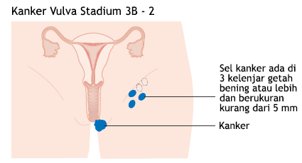 Ilustrasi Kanker Vulva Stadium 3B - 2