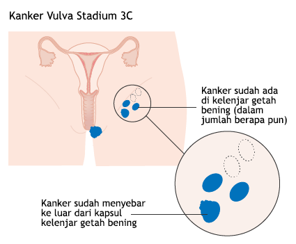 Ilustrasi Kanker Vulva Stadium 3C