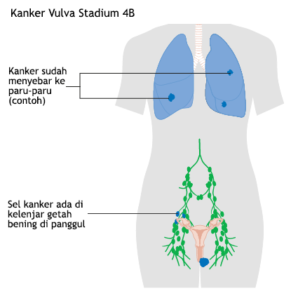 Ilustrasi Kanker Vulva Stadium 4B