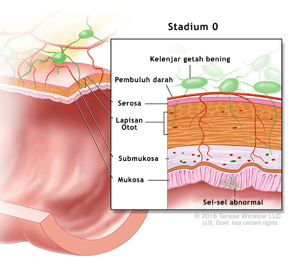 Kanker Usus Stadium 0