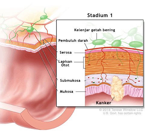 Kanker Usus Stadium 1