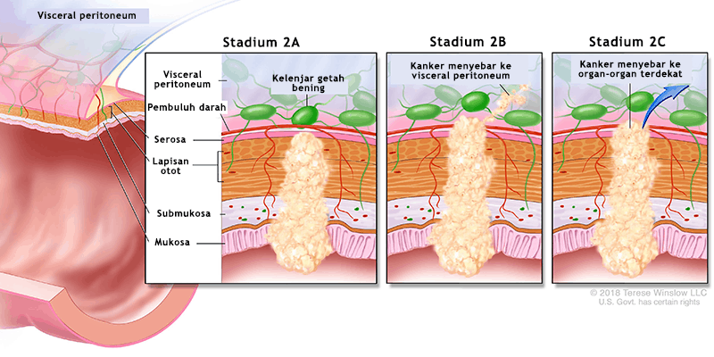 Kanker Usus Stadium 2