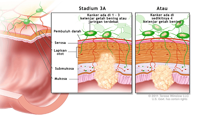 Kanker Usus Stadium 3A