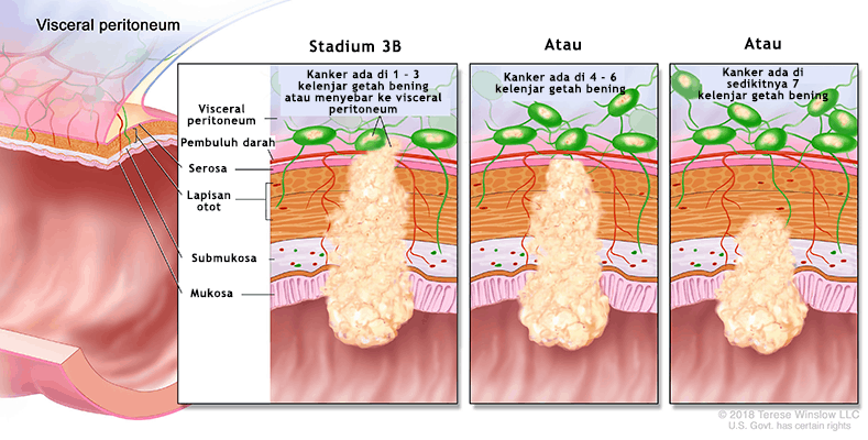 Kanker Usus Stadium 3B