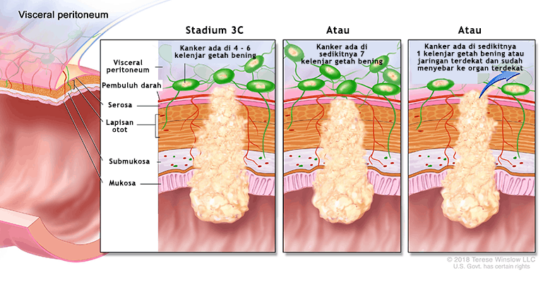 Kanker Usus Stadium 3C