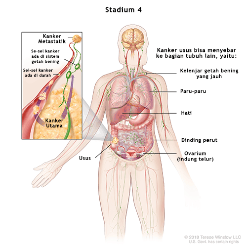 Kanker Usus Stadium 4