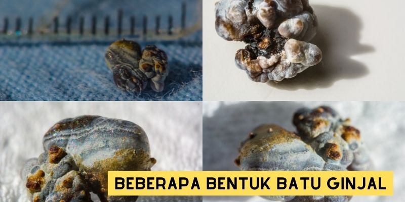 Gambar Bentuk Batu Ginjal yang Dikeluarkan