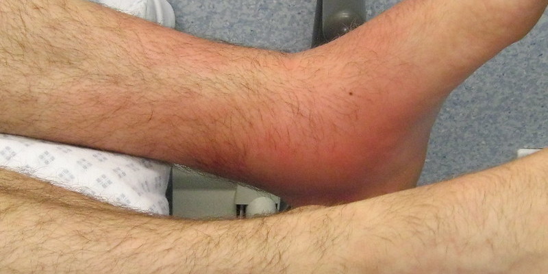 Gambar Penyakit Selulitis