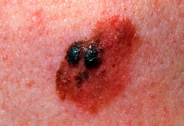 Gambar Tahi Lalat Melanoma - Warna
