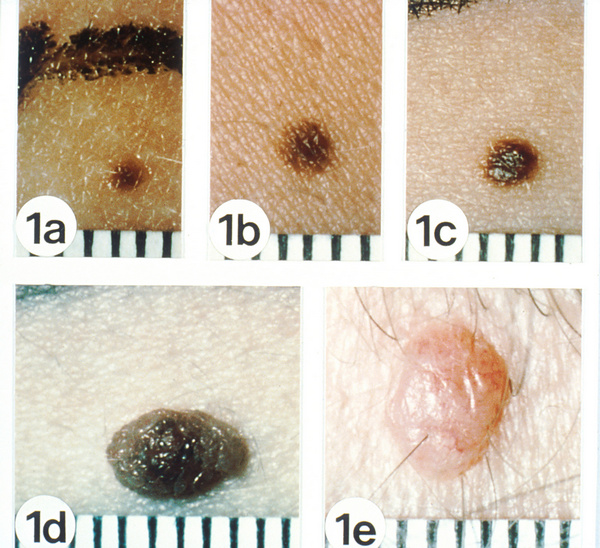 Gambar Tahi yang Lalat Normal - Pinggiran