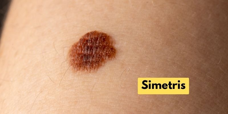 Gambar Tahi Lalat Normal - Simetris