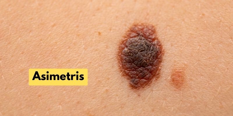 Gambar Tahi Lalat yang Berbahaya - Asimetris